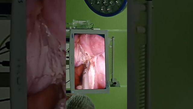 удаления матки(1) смотреть онлайн