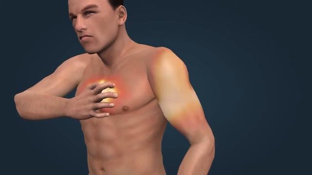 Инфаркт миокарда | Анатомия человека | Биология смотреть онлайн