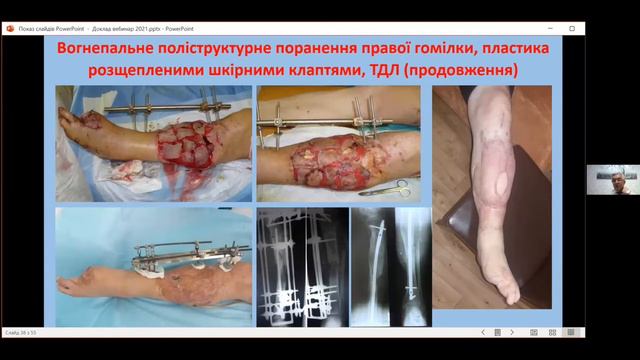 Вебінар - Особливості закриття вогнепальних дефектів тканин смотреть онлайн