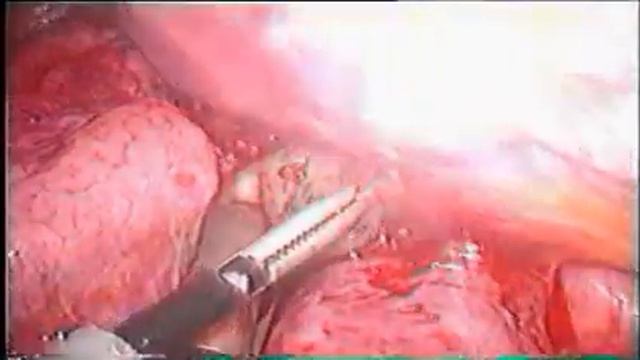 Biopsy of mediastinal lymphnodes 2001 смотреть онлайн