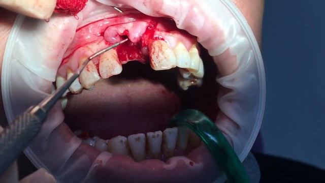 Костная пластика смотреть онлайн