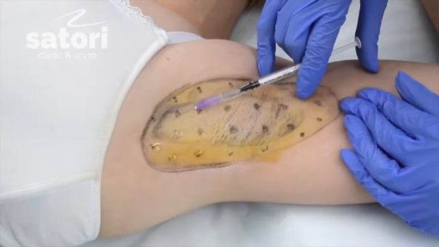 Лечение гипергидроза в Самаре смотреть онлайн