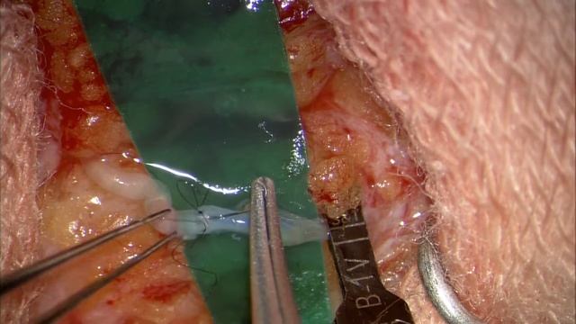 Lymphovenous anastomosis - End to end technique смотреть онлайн