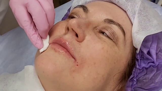 АирисКом студенты учатся: семинар по филлерам, заполнение морщин марионеток.