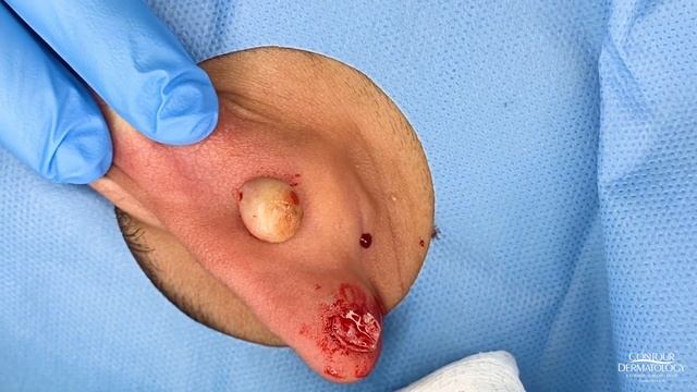 Keloid Scar Removal | Contour Dermatology