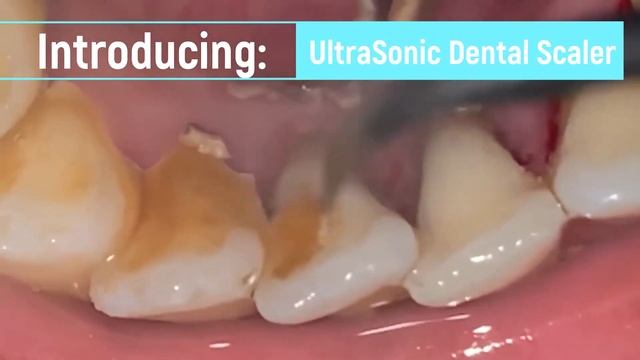 Ultra Sonic Dental Scaler смотреть онлайн