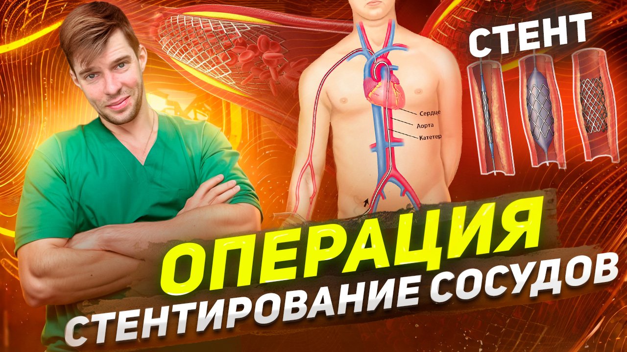 Операция стентирование - ЦЕНА? Сколько прослужит стент и что это такое? смотреть онлайн