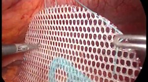 Лапароскопическая пластика пупочной грыжи