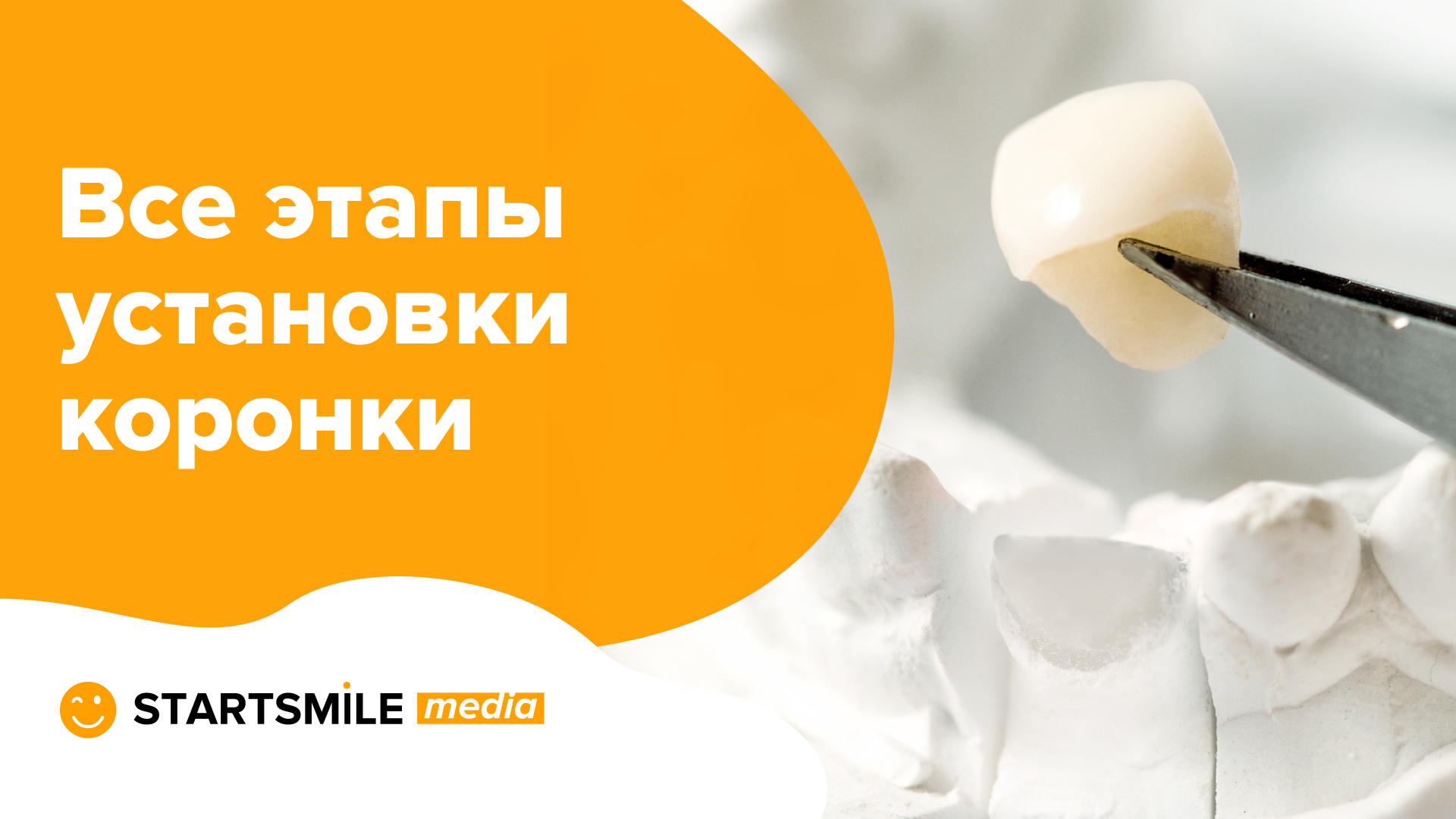 Установка коронки на зуб | Подготовка и все этапы операции смотреть онлайн