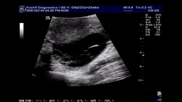 Ovarian Hemorrhagic Cyst Ultrasound || DD || Complications || Prognosis || Role of Surgery смотреть онлайн