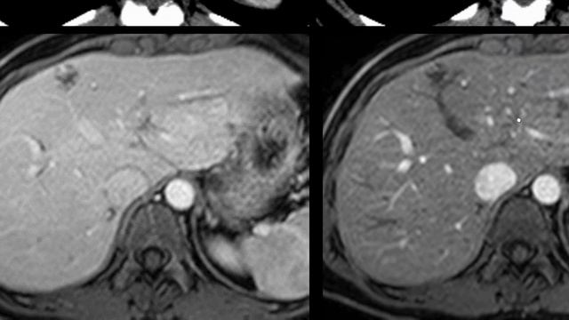 radiology hepatic hemangioma-typical/atypical. FRCR exam viva/oral смотреть онлайн