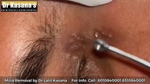 Blackheads & Milia Removal by Dr.Lalit Kasana