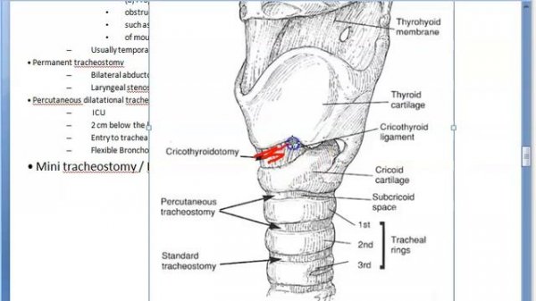 ENT Types of Tracheostomy Tracheotomy difference level High mid low Percutaneous dilatational Mini