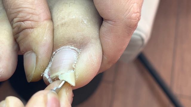 Professional Pedicure: Very Long Toenails!【Pedicure Master Lin Jun】