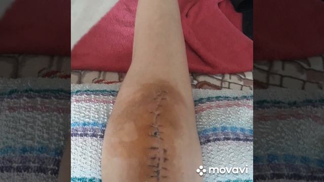 Перелом надколенника со смещением. смотреть онлайн