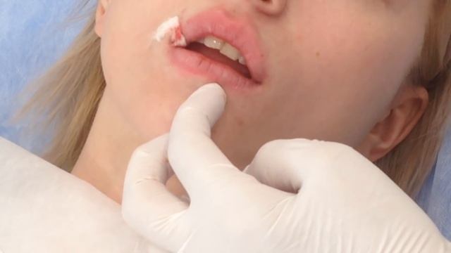 Аириском: обучение косметологии. Первая практика студентов: заполнение губ филлером