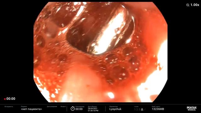 Mallory-Weiss Syndrome. Endoscopic Treatment Bleeding. Forrest IB. С-м Мелори-Вейса, гемостаз