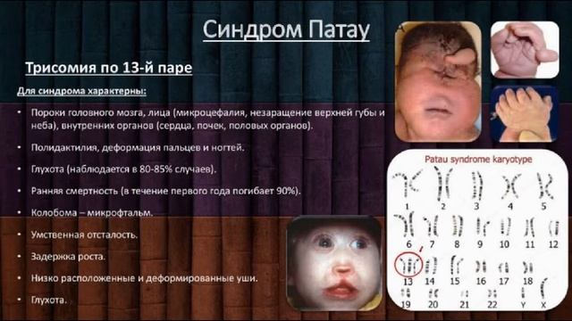 Синдром Патау. Причины, симптомы, диагностика и лечение заболевания смотреть онлайн
