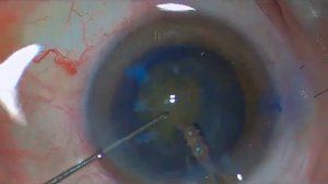 Удаление хрусталика (ФЭК+ИОЛ)