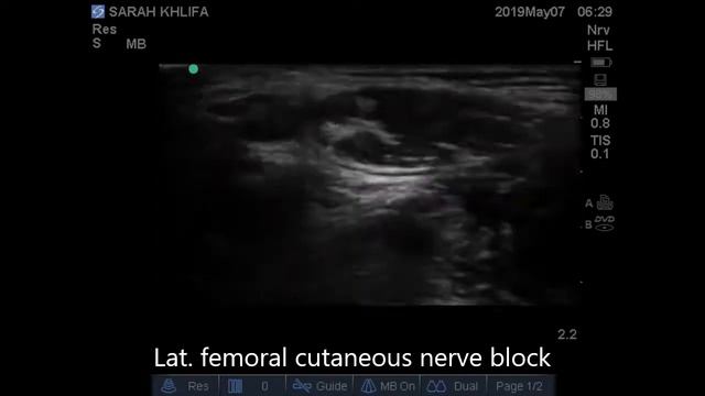 Pediatric femoral sciatic lat femoral смотреть онлайн