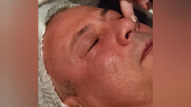 омоложение лица Вовчику.😍 смотреть онлайн