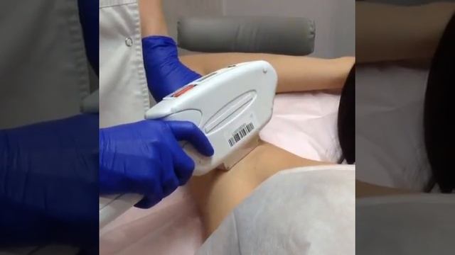IPLASER эпиляция смотреть онлайн