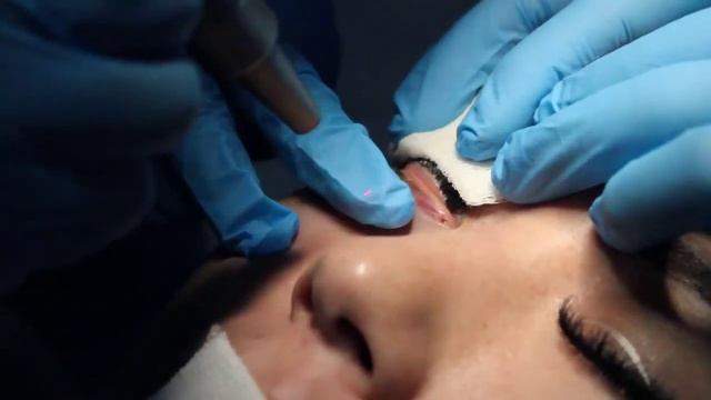 Удаление ксантелазмы лазерным методом. смотреть онлайн