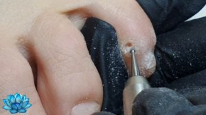 Стержневая мозоль удаление. Мозоль на стопе.