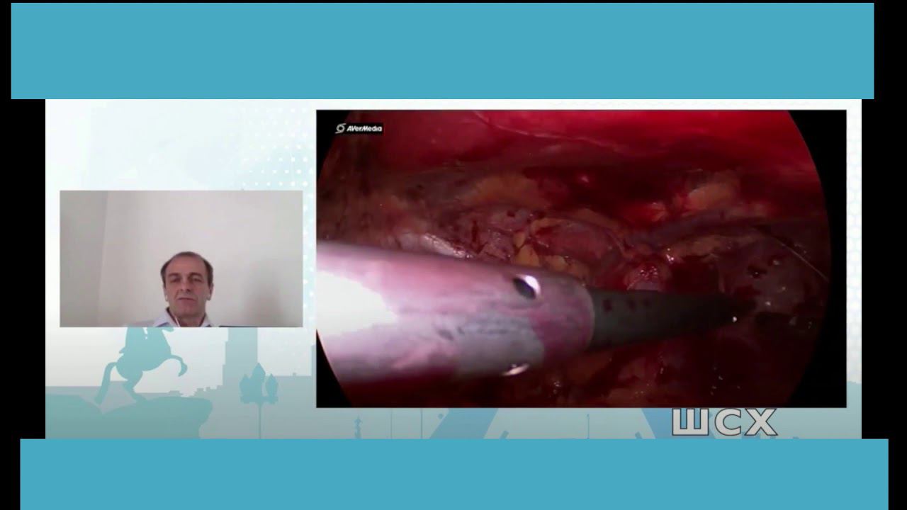 Laparoscopic ETEP Inguinal Hernia видеолекция полное видео