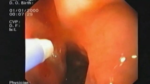 Техника проведения аргоноплазменной коагуляции при язвенных гастродуоденальных кровотечениях. смотреть онлайн