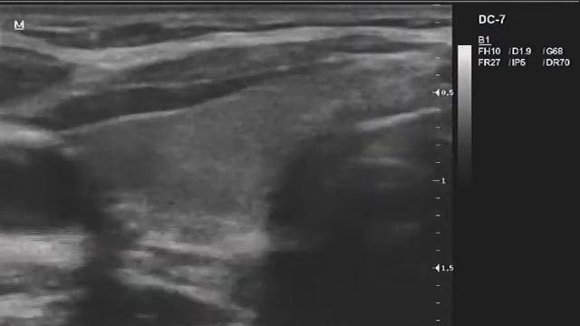 Видеозапись УЗИ - Солидный узел - TIRADS 4 смотреть онлайн