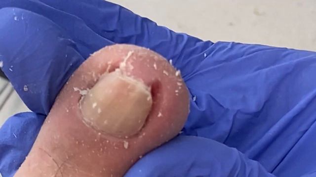 Toenails Are Bent And Embedded, Professional Pedicure To Solve Pain【Dr. Liu's Pedicur】