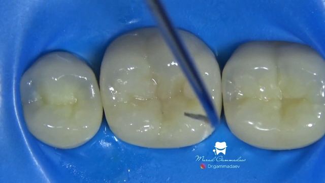 Прямая композитная реставрация нижнего шестого зуба.