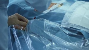 Эмболизация маточных артерий