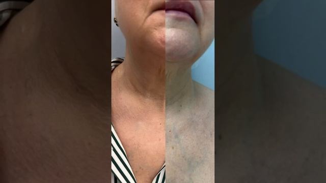 RF лифтинг лица Morpheus 8