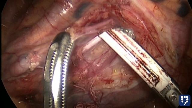 Laparoscopic Low Anterior Resection with Sentinel Lymph Node Guided Lymphadenectomy смотреть онлайн