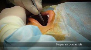 Удаление комков Биша