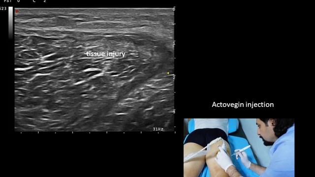 Ultrasound guided M biceps femoris (long head strain) injection смотреть онлайн