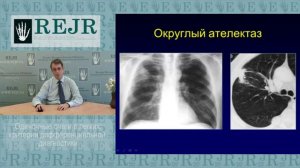 Одиночные очаги  в легких   критерии дифференциальной диагностики