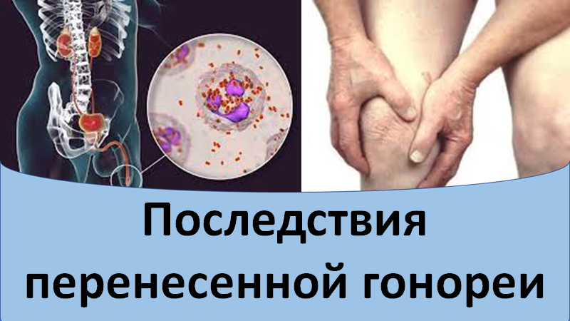 Последствия перенесенной гонореи смотреть онлайн