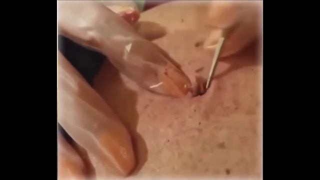 УДАЛЕНИЕ ЖИРОВИКА С ТЕЛА ЧЕЛОВЕКА. ЧТО ЭТО ВООБЩЕ БЫЛО?????!!!!!