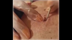 УДАЛЕНИЕ ЖИРОВИКА С ТЕЛА ЧЕЛОВЕКА. ЧТО ЭТО ВООБЩЕ БЫЛО?????!!!!!