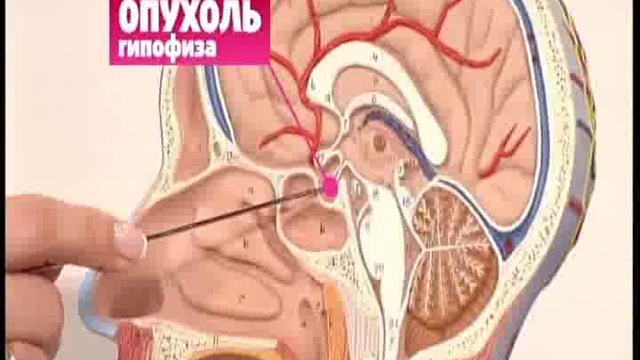 Опухоль мозга вызывает ожирение смотреть онлайн