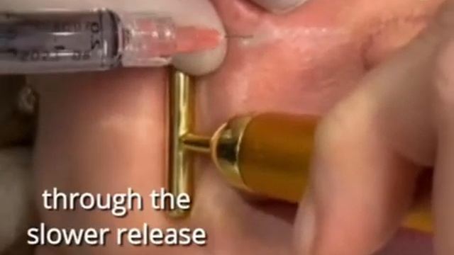 PROFHILO, BIO-REMODELLING