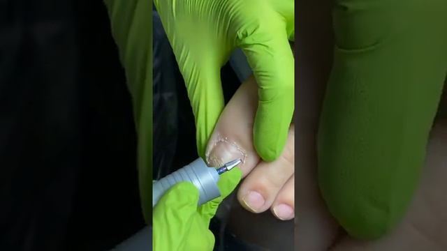 Романова Онихолизис 01 смотреть онлайн