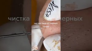 черный точки прищы угри как избавиться от прыщей как избавиться от угри get rid of acne