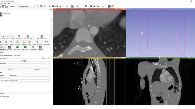 Fast marching segmentation in 3D Slicer смотреть онлайн