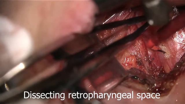 Transoral retropharyngeal lymph node dissection смотреть онлайн