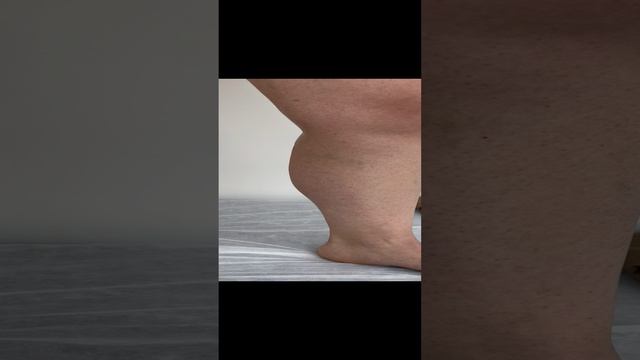 Тромбоз из-за некачественного компрессионного трикотажа. Флеболог Москва смотреть онлайн