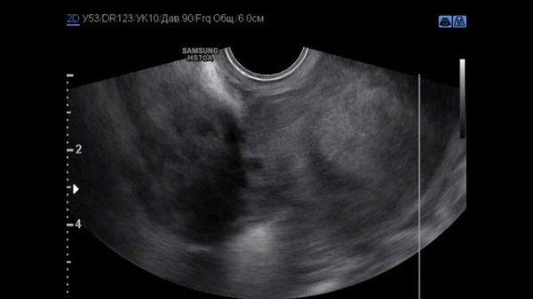 Шеечная миома матки больших размеров. Barto-clinic.ru